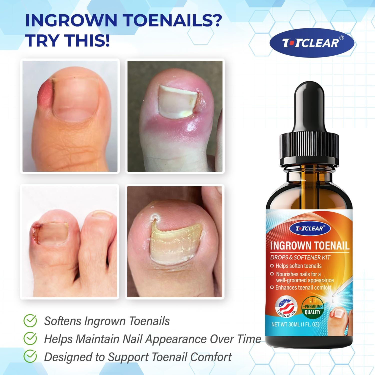 Ingrown Toenail Drops: Ingrown Toenail Tool for Men Women - Big Toe Ingrown Nail Tool - Ingrown Toenail Removal Kit - Ingrown Toenails Softener Kit with Toe Caps - Ingrown Toenails Solution - 30Ml