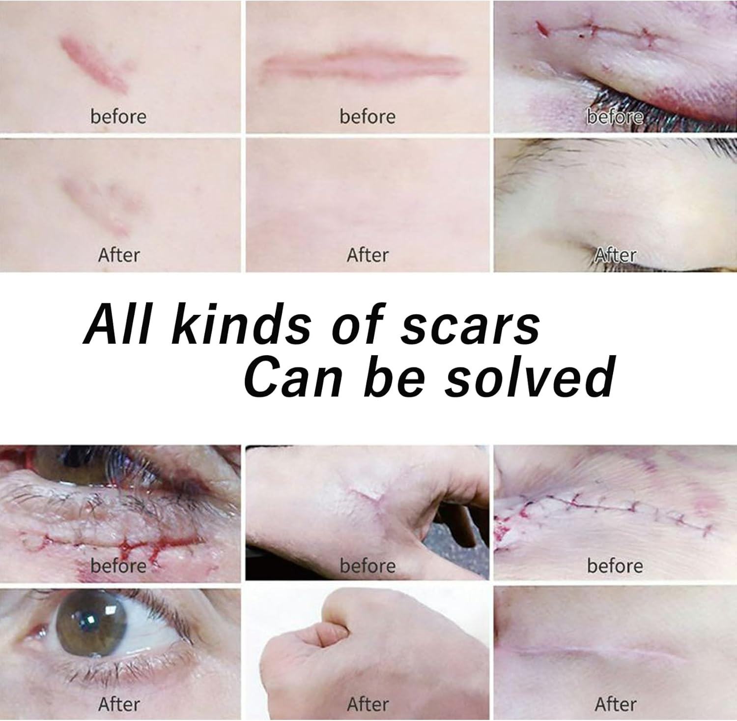 Silicone Scar Sheets Roll (1.6&rdquo;X60&rdquo; | 4Cmx150Cm) Medical Grade Reusable & Waterproof Scar Removal Patch Scar Tape for Keloid C-Section Burns and Acne Scars image number 4