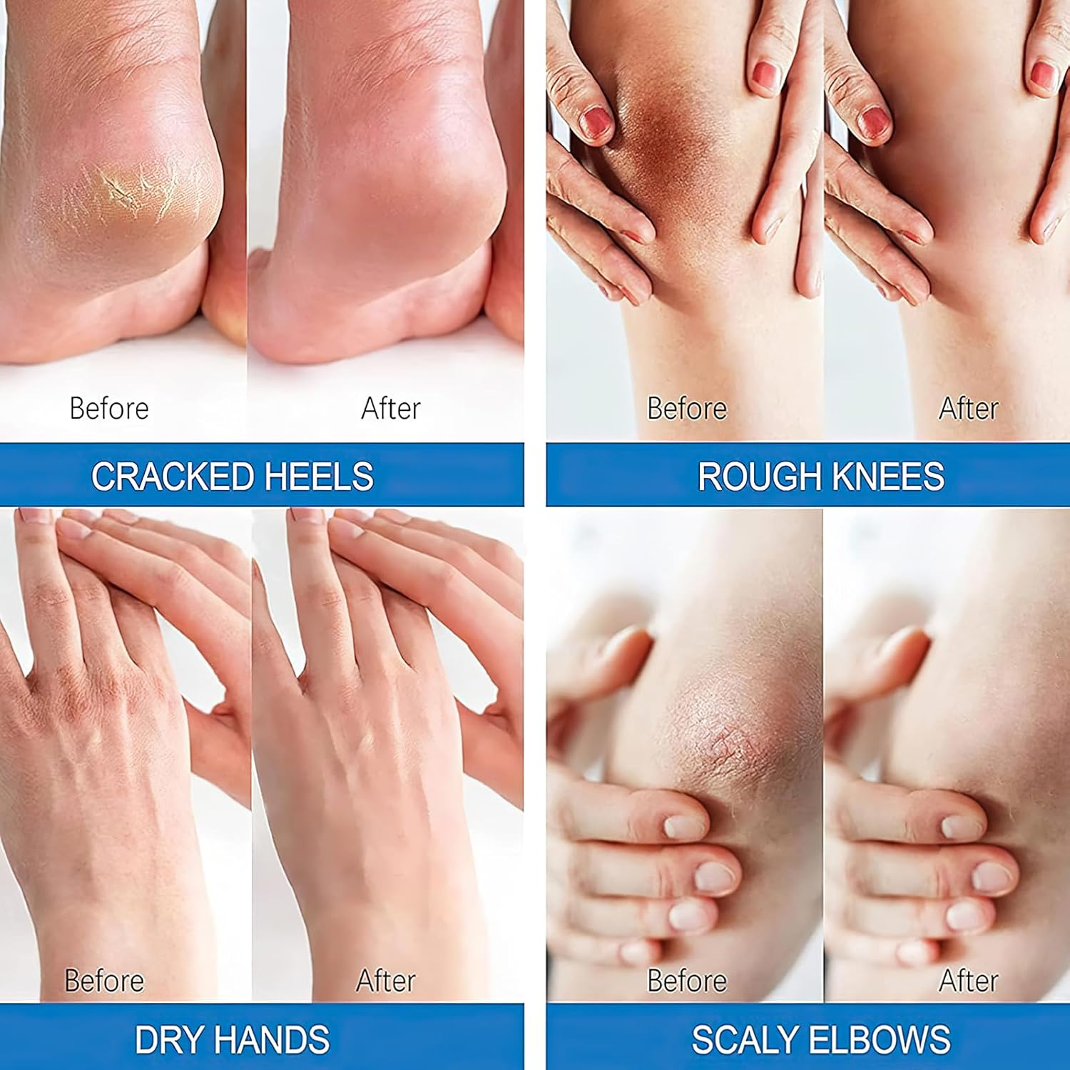 Urea Cream for Feet and Hands - 40% Urea Cream+ 2% Salicylic Acid for Maximum Moisturizing and Softening, Moisturizing Cream for Dry, Cracked Feet, Hands, Elbows and Knees(4.6 Oz) image number 2