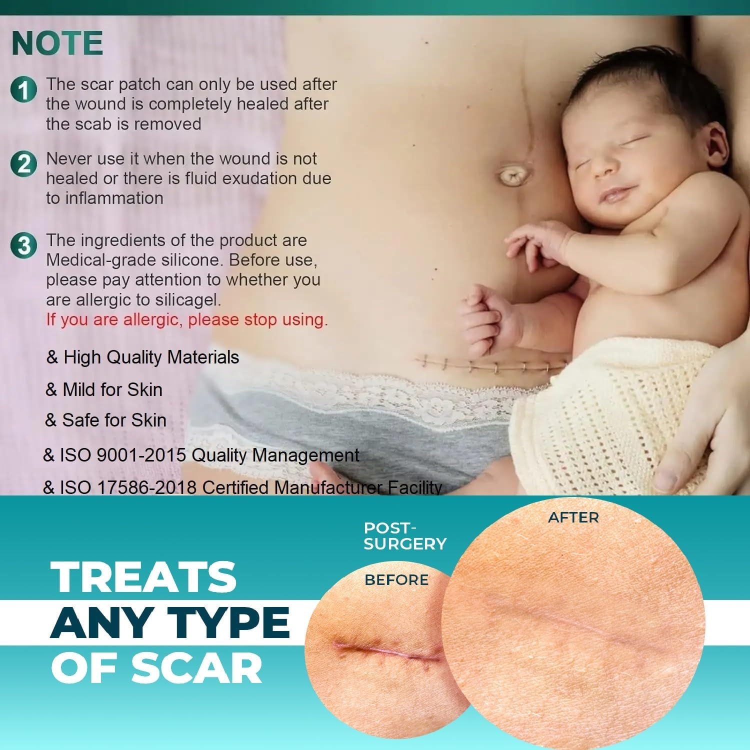 Silicone Scar Tape, Advanced Professional Removal Patch Strips, Reusable Sheets, for Keloid Scars, C Section, Burn, Scratch, Birthmarks, Tummy Tuck, Acne Etc., Works with Old and New Scar (4X150Cm Roll) image number 3