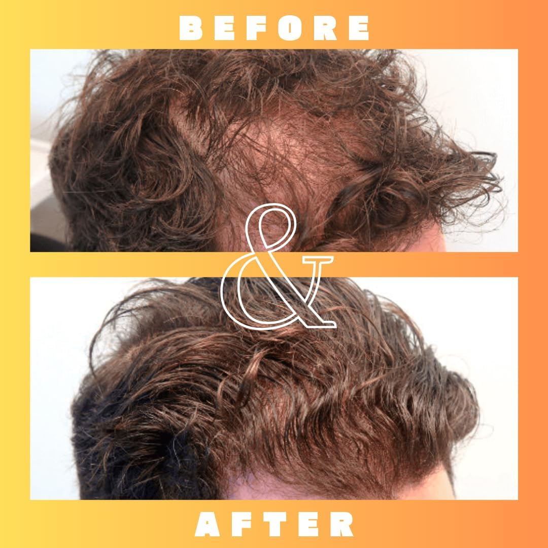 Mettle Mane - RU58841 5% Solution (50Mg/Ml) Hair Serum - 30Ml Bottle image number 2