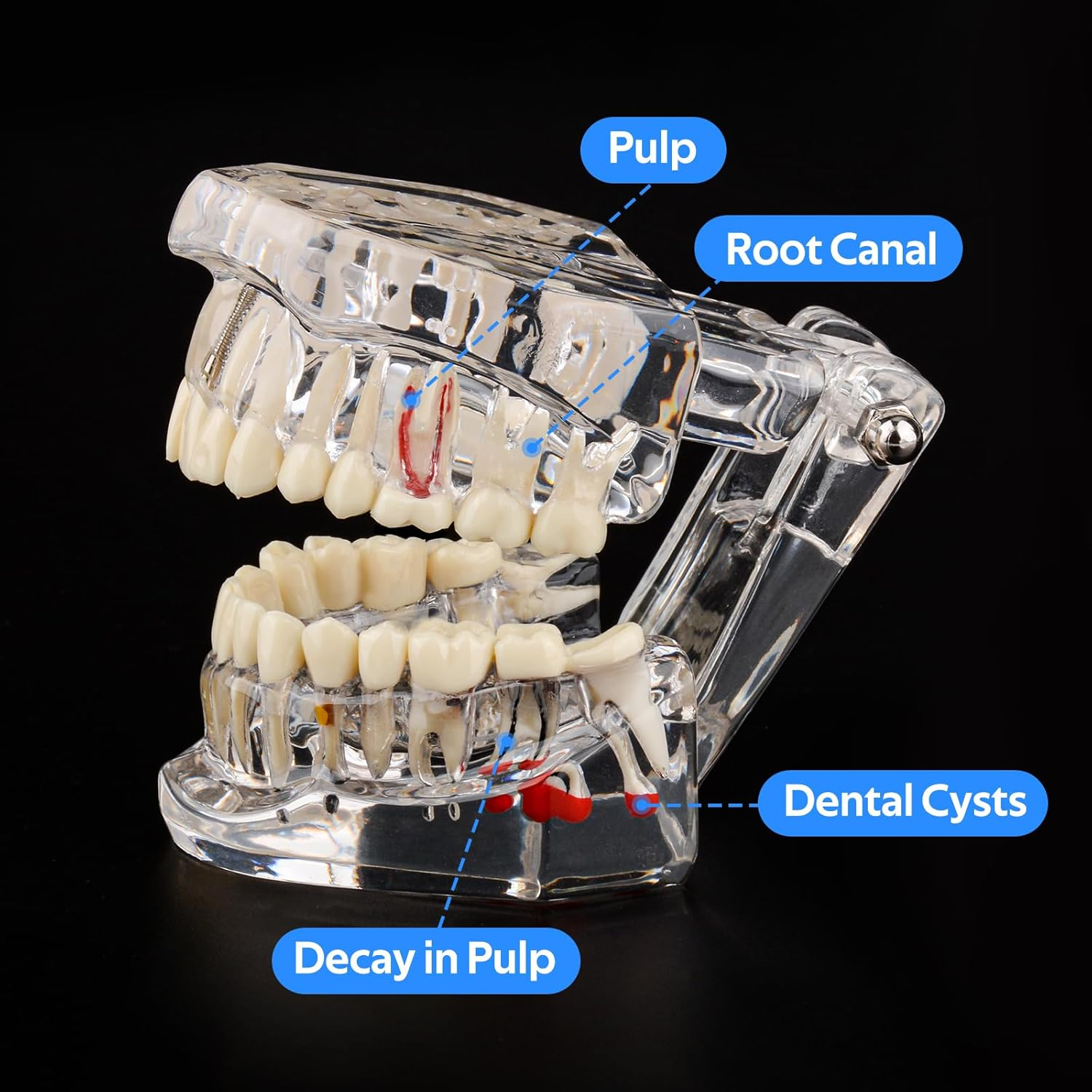Ultrassist Transparent Disease Teeth Model image number 2