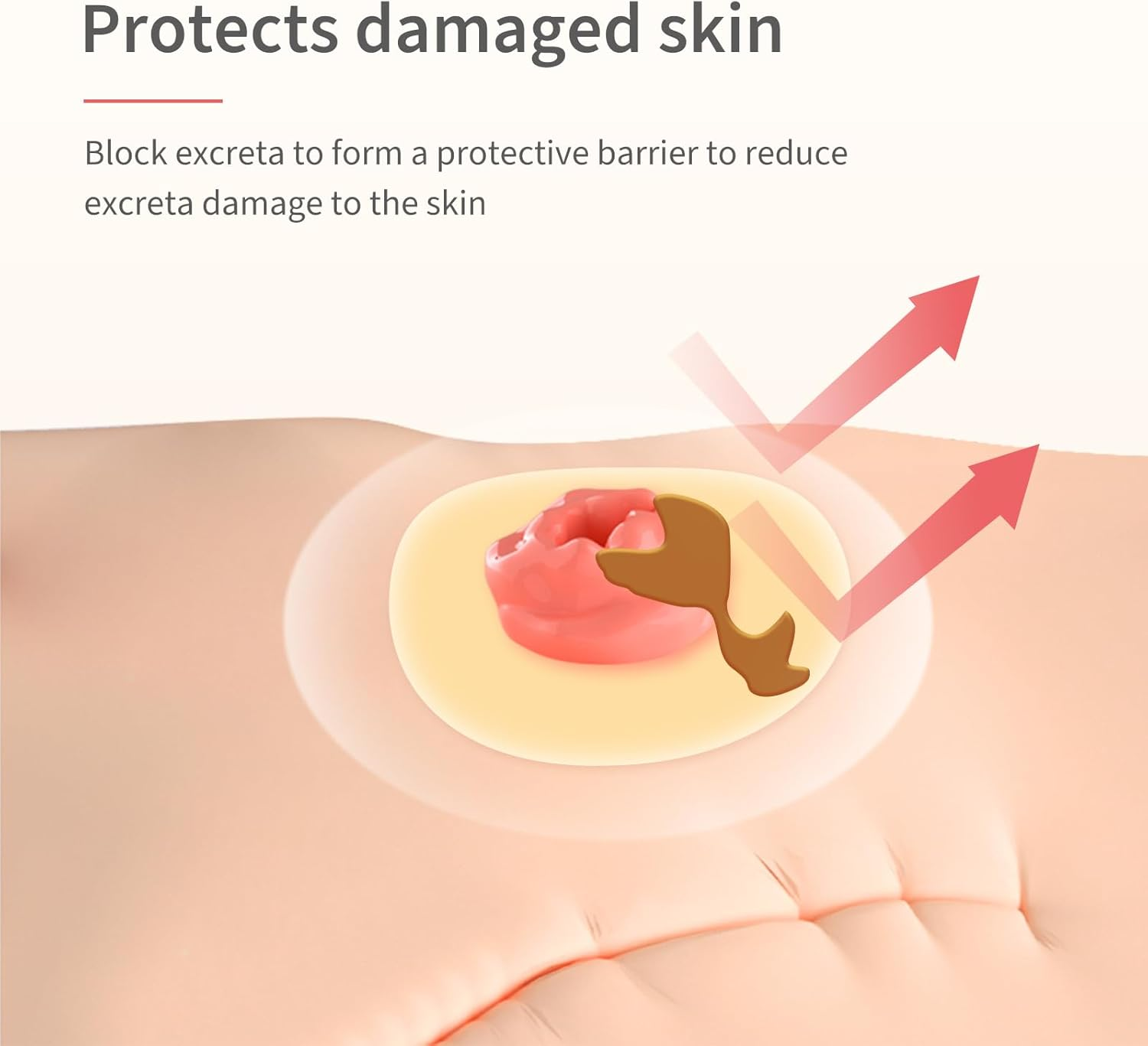 DERAYMI 10 Pack Moldable Ostomy Barrier Rings, 2Mm Thickness Sting-Free Elastic Ostomy Rings Hydrocolloid Ileostomy Barrier Rings Secure Seal for Colostomy Bags image number 5