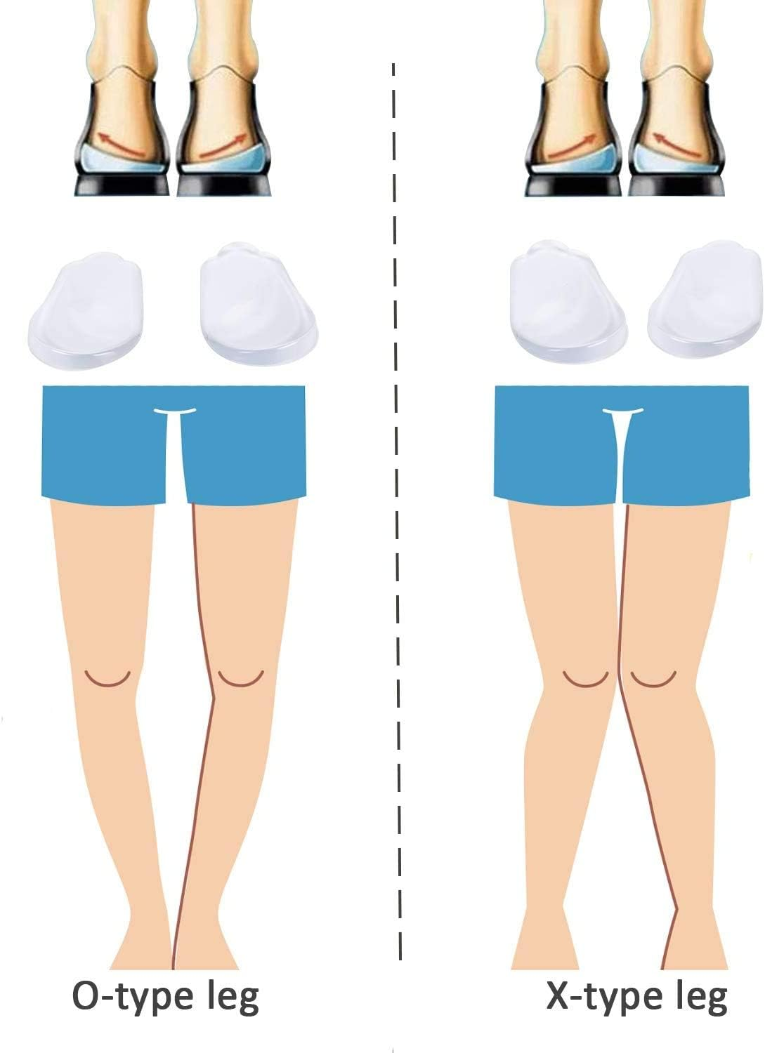 Medial & Lateral Heel Wedge Silicone Insoles - Supination & Pronation Corrective Adhesive Shoe Inserts Foot Alignment, Knock Knee Pain, Bow Legs, O/X Type Leg, Oste, Oarthritis (4 Pairs), 4 Pairs