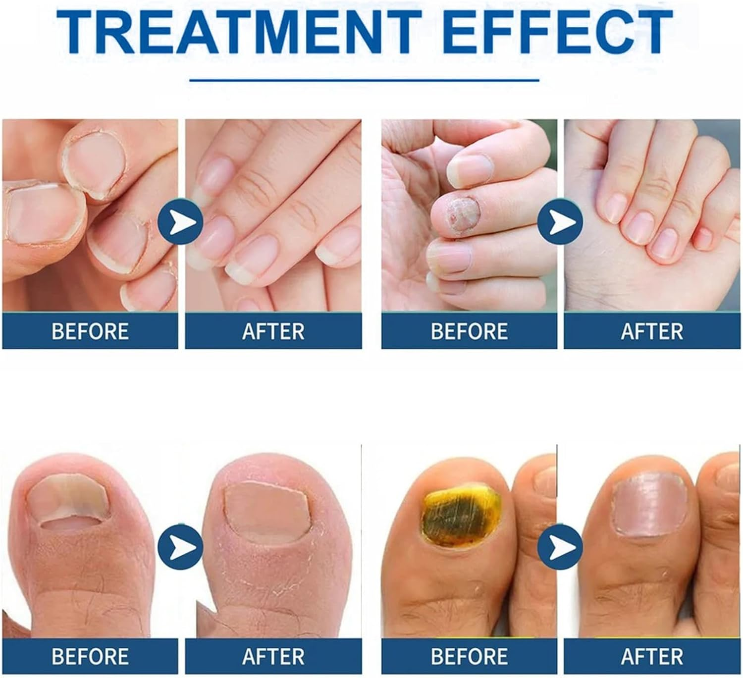 Antifungal Nail Pen for Toenails and Fingernails, Extra Strength Fungus Treatment & Repair Serum with Natural Ingredients, Nail Strengthener and Growth Support (2 PCS)