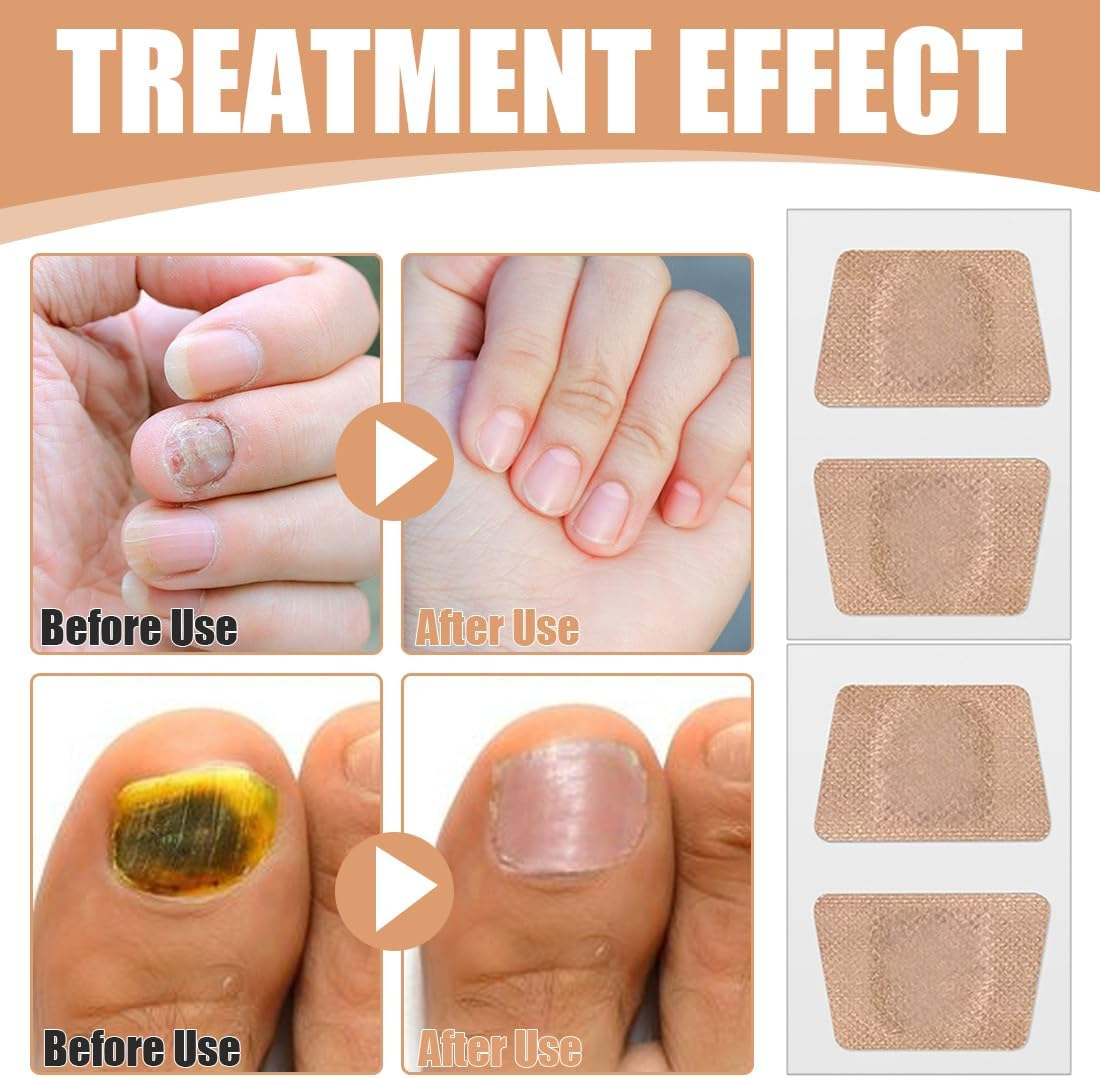 LQIOACU Pack of 32 Toenail Treatment, Split Nail Repair Strengthening Nails, Nail Digging Repair Plasters for Damaged and the Appearance of Discoloured Nails image number 5