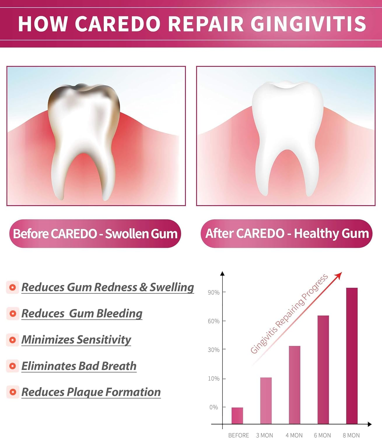 CAREDO Gingivitis Treatment Toothpaste for Gum Repair, Bleeding & Swollen Gums Relief, Gum Disease & Inflammation Care, Reverse Gingivitis Oral Treatment for Adults, 3.52 Oz