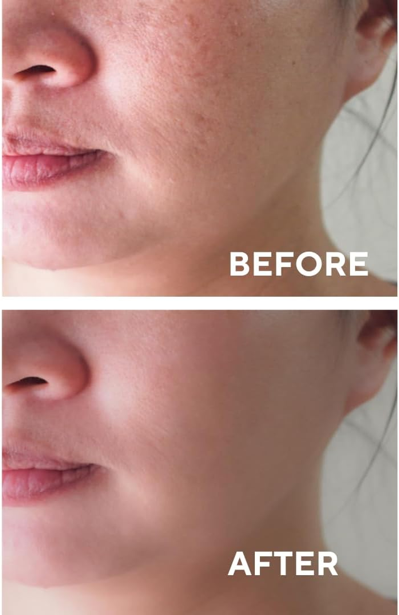 Facial Peeling Serum with 10% AHA 2% BHA, Saliscylic Acid Serum for Blemishes, Chemical Peel at Home, Glycolic Acid Peel with Hyaluronic Acid,Aha and BHA, 1.00 Fl.Oz (30 Ml) image number 1