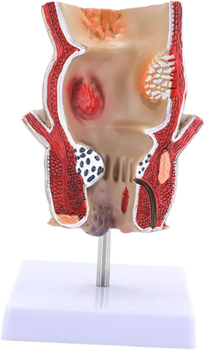 Eigell Human Pathology Rectal Model Educational Display Tool for Study School image number 1