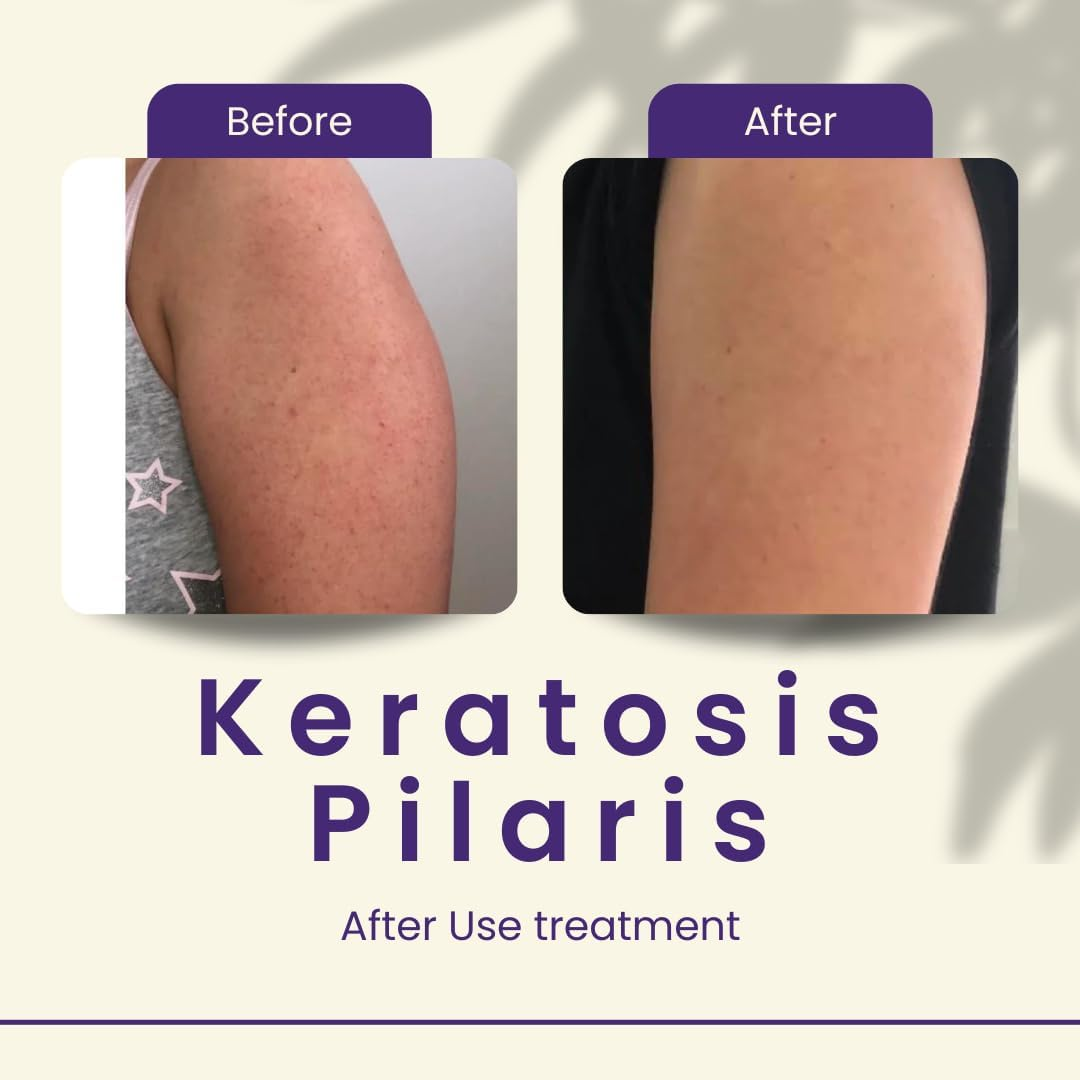 Areton Bump Eraser Body Bump Eraser Exfoliant for Keratosis Pilaris Cream with 5 Active Ingredients Kojic Acid, Lactic Acid, Glycolic Acid, Niacinamide & Salicylic Acid | Rough Skin image number 1