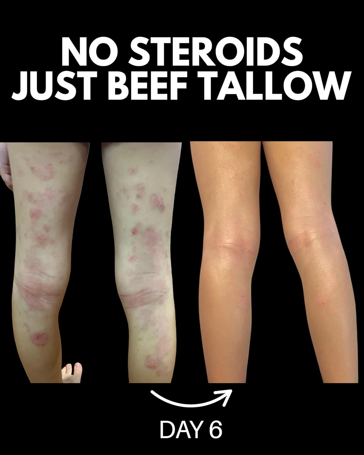Beef Tallow for Skin | Pure Grass Fed Beef Tallow Moisturiser, Deep Hydrating, Anti-Inflammatory, Non-Comedogenic | Fat Lab Tallow (30G) image number 2