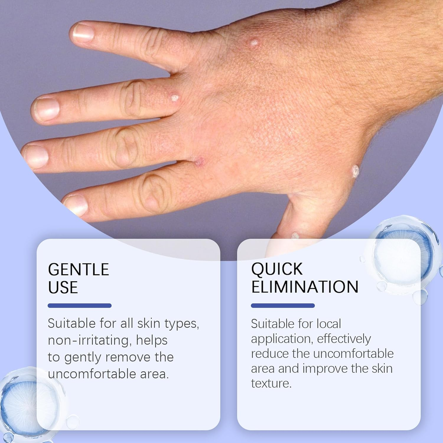 Wart Remover Cream 30G, Suitable for Common Warts, Plantar Warts, Corns, Moles, Calluses and Moles, Wart Remover for Hands and Body