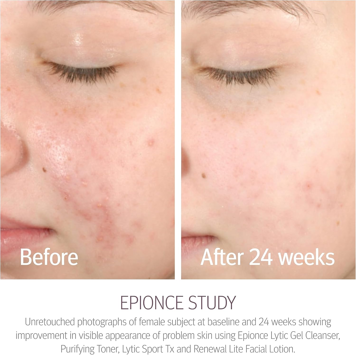 Epionce Lytic Gel Cleanser - Face Wash & Makeup Remover for Combination to Oily & Problem Skin, Oily Skin Facial Cleanser with Willow Bark & Menthol, Dermatologist Skincare image number 5