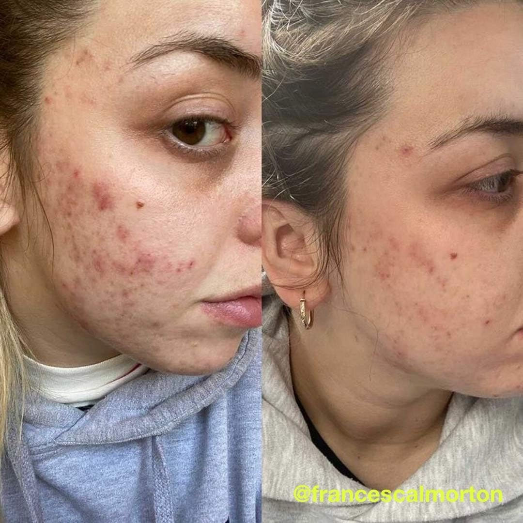 Carbon Theory | Charcoal, Tea Tree Oil & Vitamin E Breakout Control Overnight Detox Facial Serum | Natural, Vegan and Cruelty Free | 30Ml image number 5