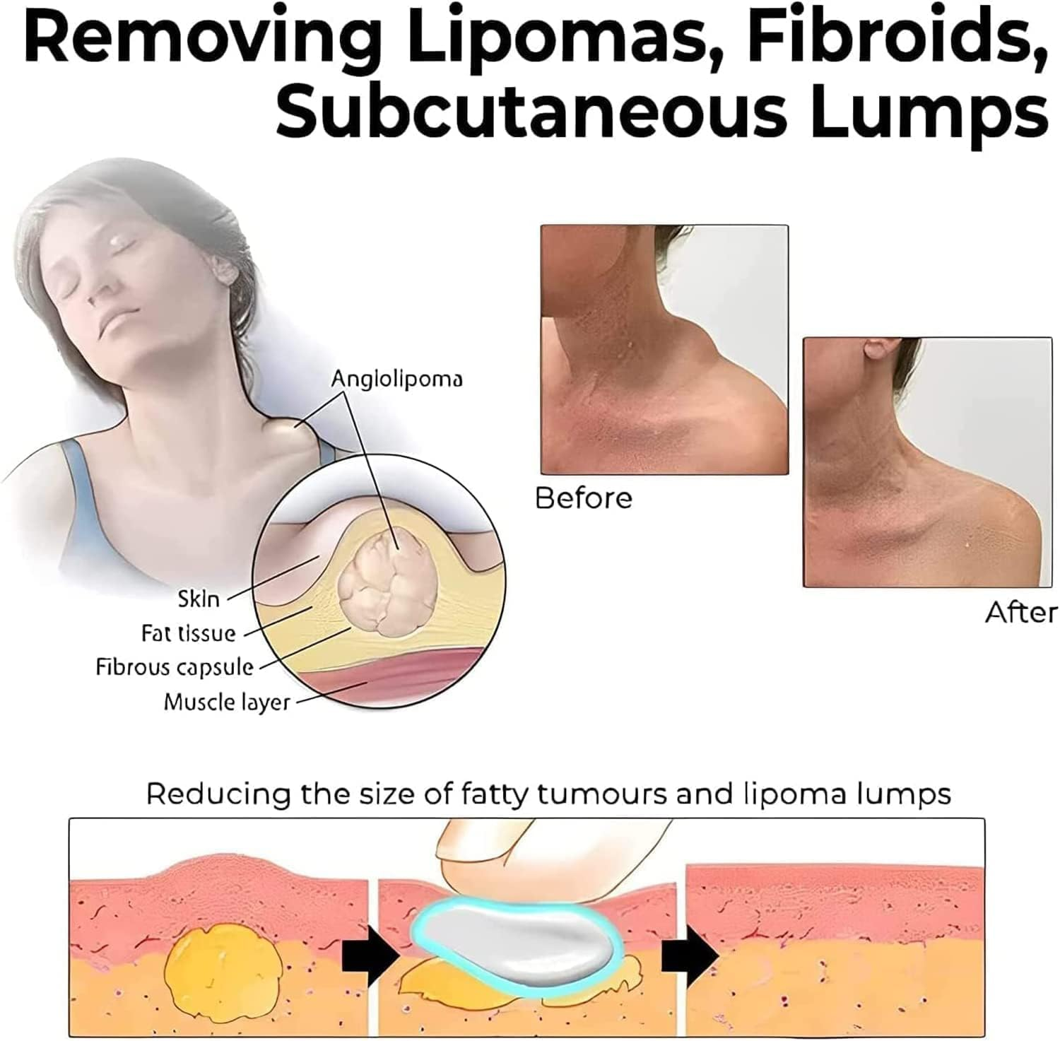 3Pcs Lipoma Removal Cream,Huangfutang Lipoma Removal Cream,Herbal Lipoma Removal Cream,Safe and Effective Get Rid of Your Fatty Lumps image number 1