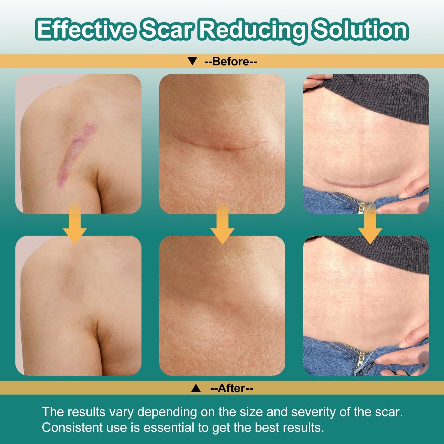 VICHYIE Silicone Scar Tape, Great Adhesion, Skin-Friendly, Reusable, Silicone Scar Sheets for Surgical/Trauma/Keloids/Acne Scars (4 X 150Cm) image number 2