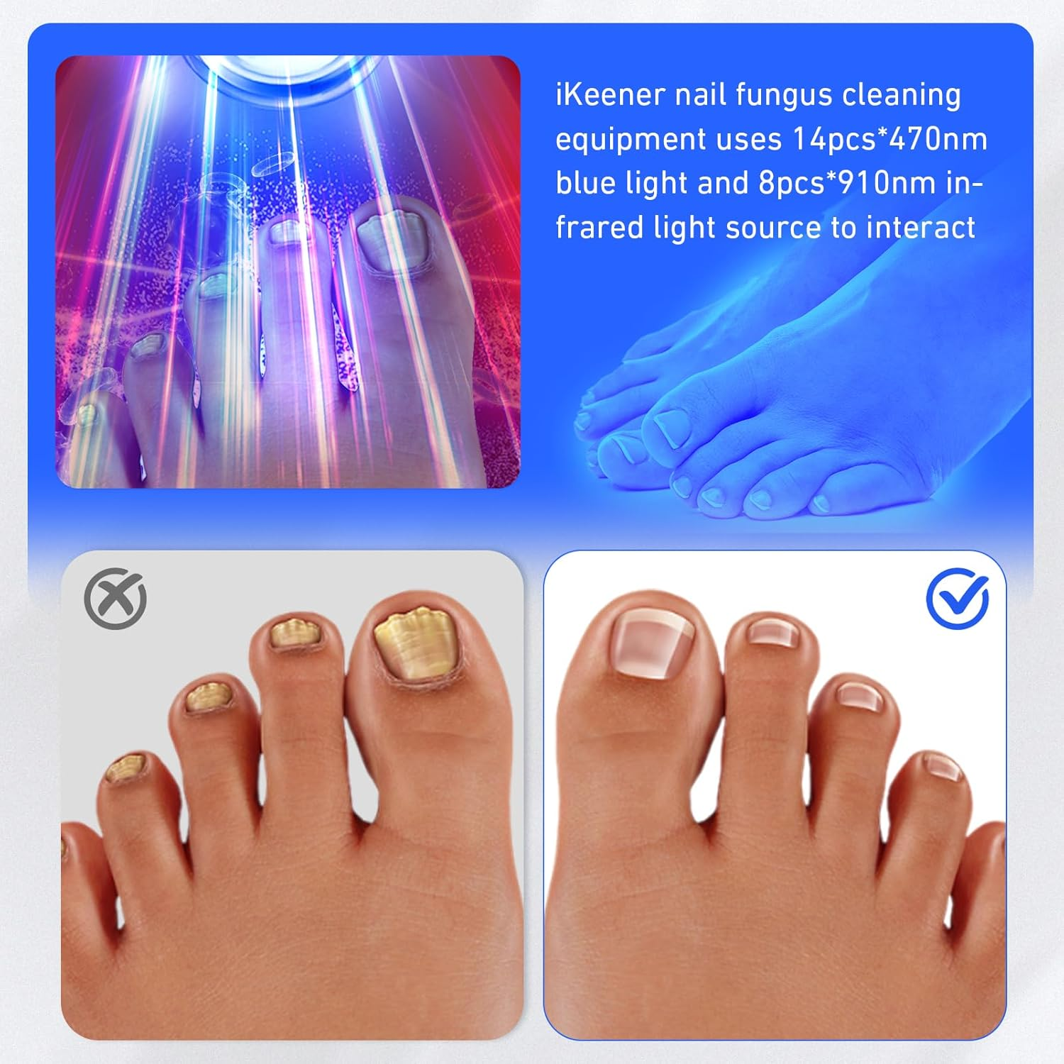 Ikeener Rechargeable Nail Fungus Laser Treatment Device, Portable 470Nm & 910Nm Fungal Nail Led Light Device for Nail Fungus Cleaning, Home Use image number 1