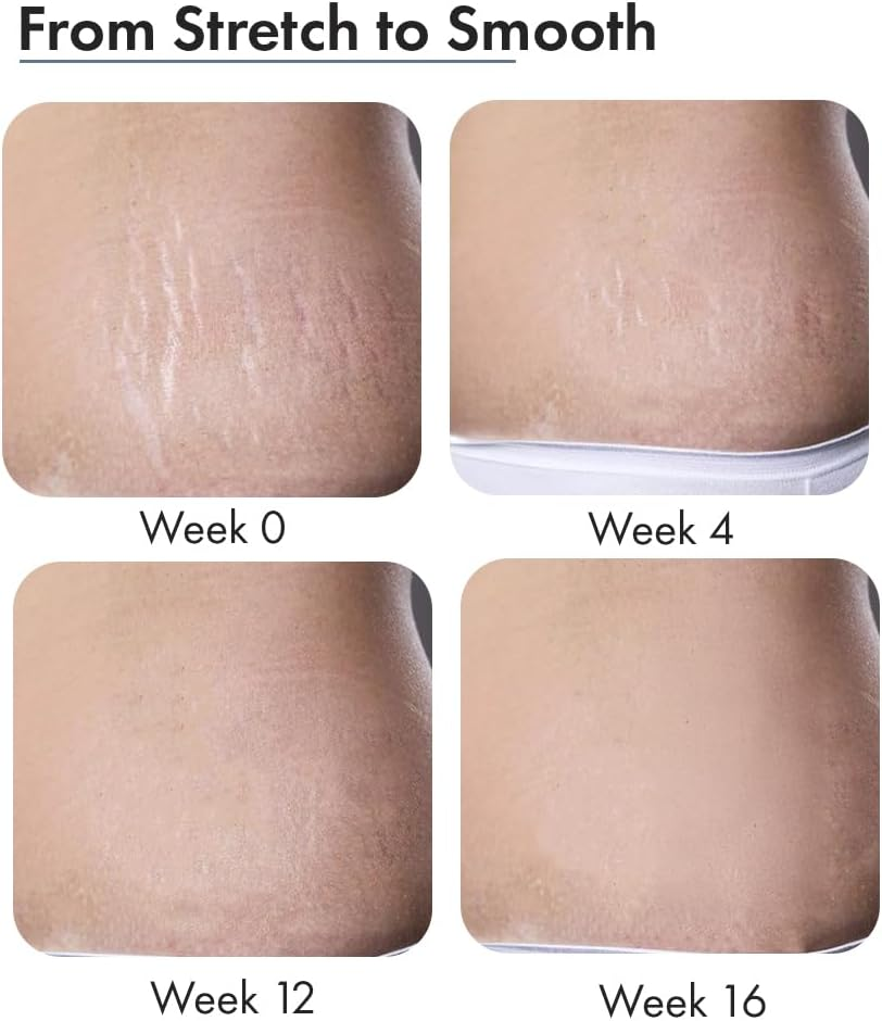 Thriveco Stretch Marks Expert Cream Pack of 2_60Ml image number 5