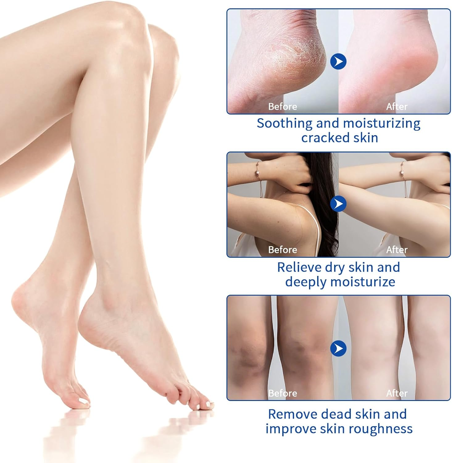 Urea Cream 60% for Feet Maximum Strength, Urea Foot Lotion with 2% Salicylic Acid for Dry Cracked Feet, Heel, Hand & Knee, 5.3 Oz Exfoliating Foot Care for Dead Skin, Softening & Deep Moisturizing image number 1