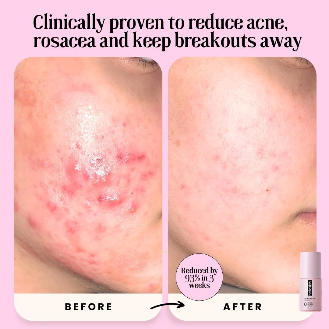 Azelaic Acid 20% & Niacinamide 10% | Helloskin anti Acne Serum (30Ml) | Face Serum for Acne Marks and Rosacea Clears Rosacea | Kills Acne | Men and Women Daily Serum for Clear Smooth, Radiant, Glowing Skin image number 6