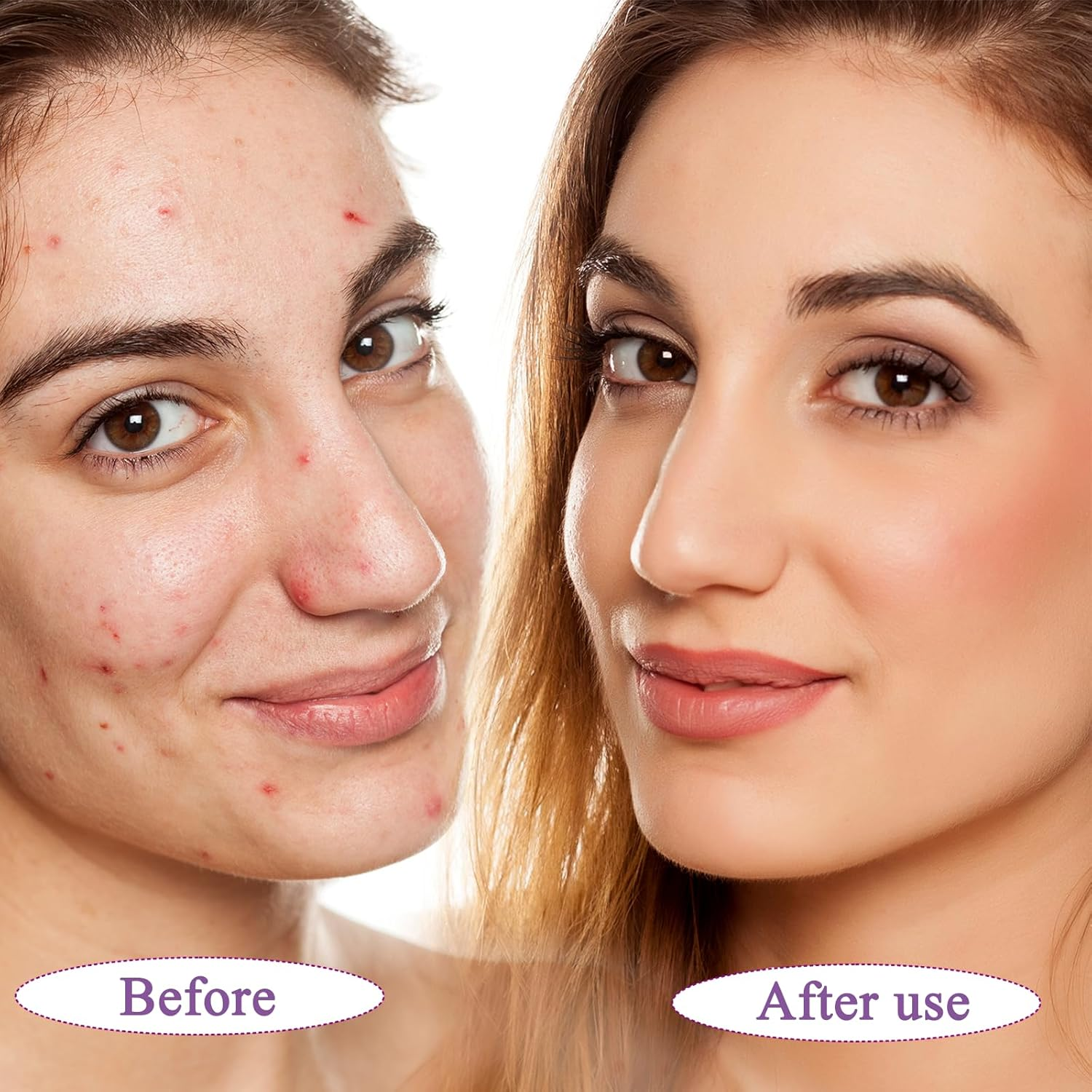 12% Azelaic Acid Serum - Brightens Skin, Clears Pores, Soothings Acne & Redness | Premium Face Treatment image number 4