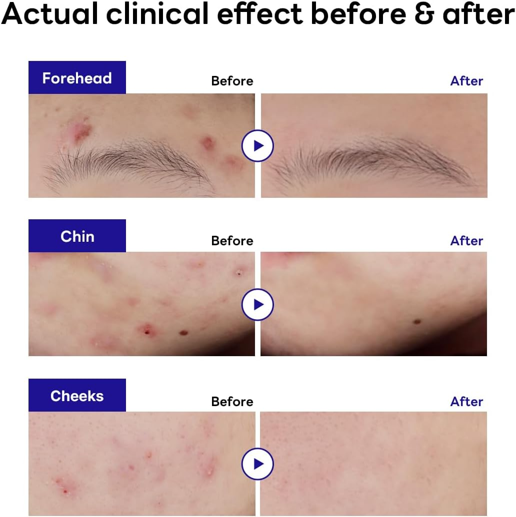 MEDIHEAL Derma Clear Teatree Treatment Spot Patch (44 Counts) - Acne Relief, Oil and Moisture Balance with Teatree & Salicylic Acid image number 4