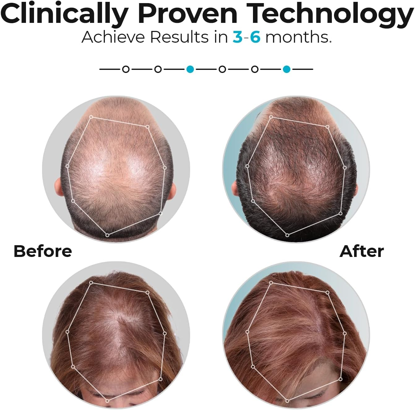 Capilluspro Mobile Laser Therapy Cap for Hair Regrowth - NEW 6 Minute Flexible-Fitting Model - Fda-Cleared for Medical Treatment of Androgenetic Alopecia - Superior Coverage image number 4