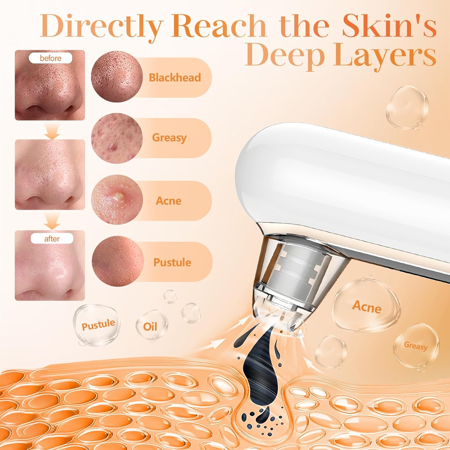 Blackhead Remover Vacuum Pore Extractor - Face Blackhead Extractor Pimple Extractor Skin Tag Remover Tool Pore Cleaner with USB Charge 4 Modes 5 Suction Heads image number 1