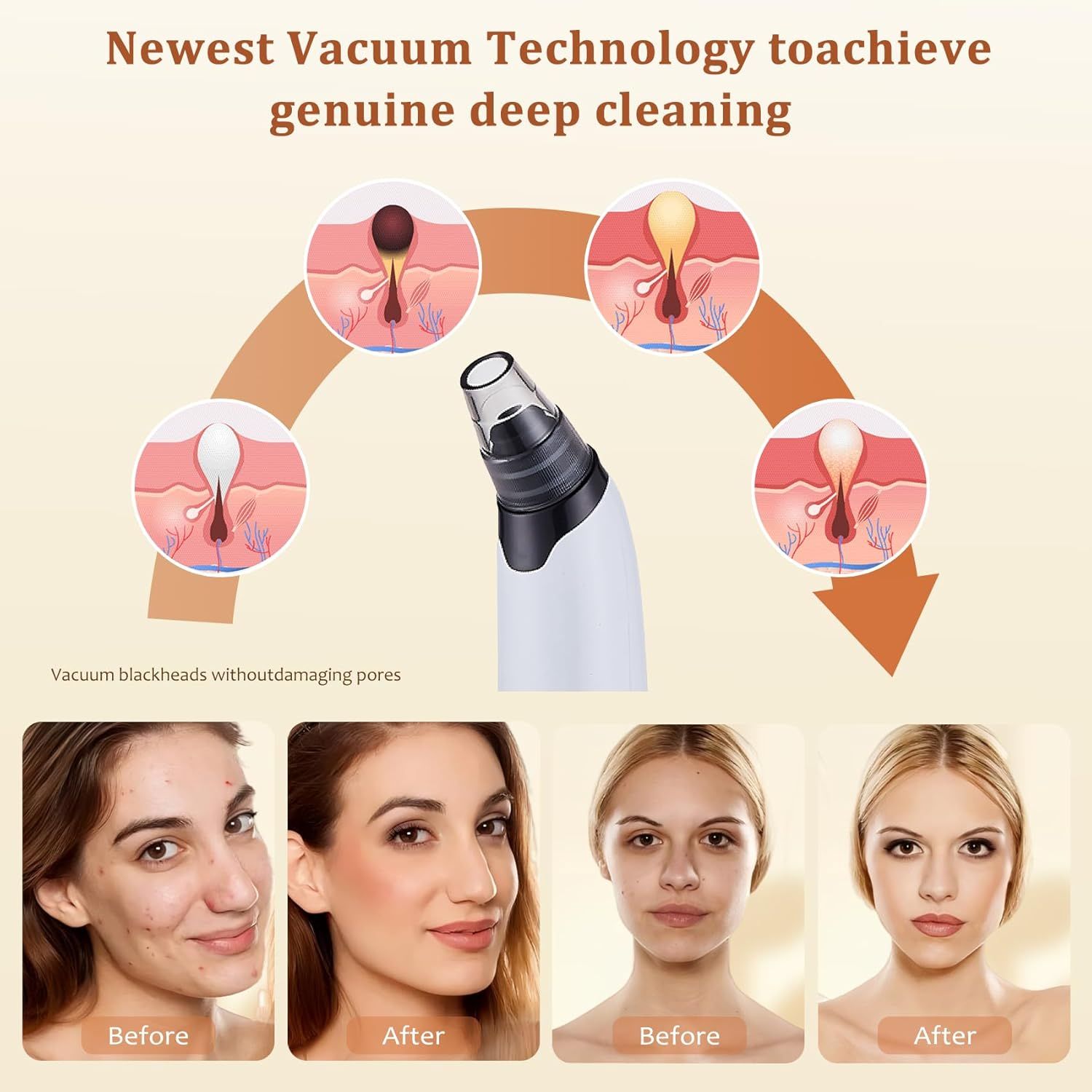 Blackhead Remover Vacuum - Powerful Pore Vacuum for Cleansing, Blackhead Extractor with 3 Adjustable Suction Levels, 4 Blackhead Removal Tools, USB Rechargeable，Suitable for Women and Men image number 1