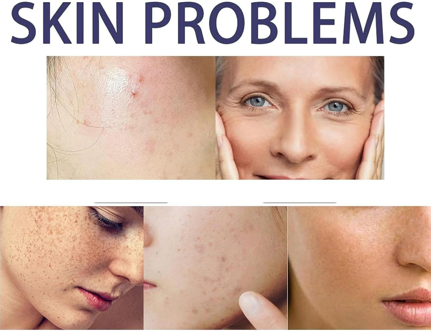 2Pcs Ac-Ne Cream - 20G Pair Ac-Ne Cream Japa, Pair Japanese Ac-Ne Cream, Long-Lasting Moisturizing, No Dryness, Ac-Ne Treat-Ment Removal Cream for Pimples Prone Skin, Mild and Harmless to Skin image number 4