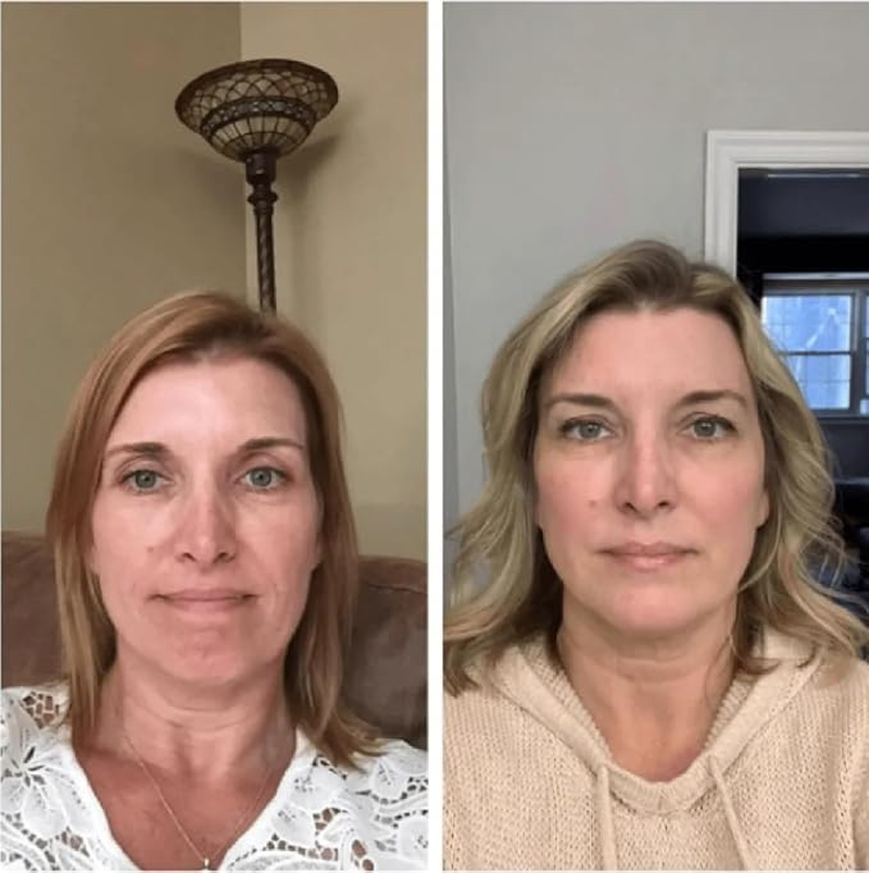 Tcatherapycare Gel Peel 60% (Professional Skin Peel) - (Level 2 Ph 1.9) - Exfoliating Face Peel &ndash; 1 Fl Oz/30Ml image number 1