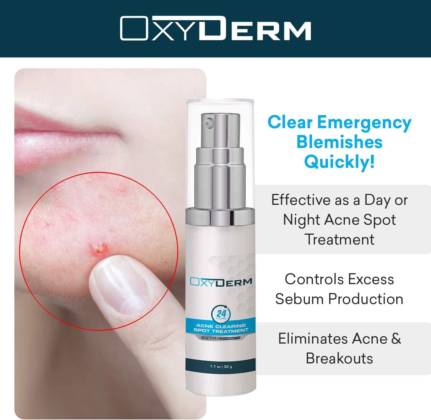 Acne Spot Treatment- Overnight Pimple Treatment for All Skin Types without over Drying Your Skin. Removal for Inflamed Blackheads, Whiteheads, Cystic Acne. Results within Hours for Adults & Teens.