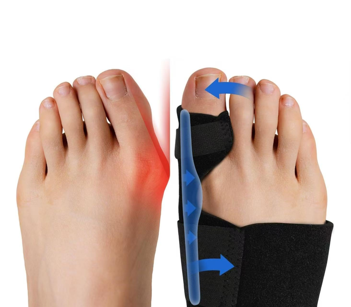 Bunion Corrector (2Pcs) Orthopedic Bunion Splint, Big Toe Separator Pain Relief, Non-Surgical Hallux Valgus Correction, Hammer Toe Straightener, Day Night Support image number 3