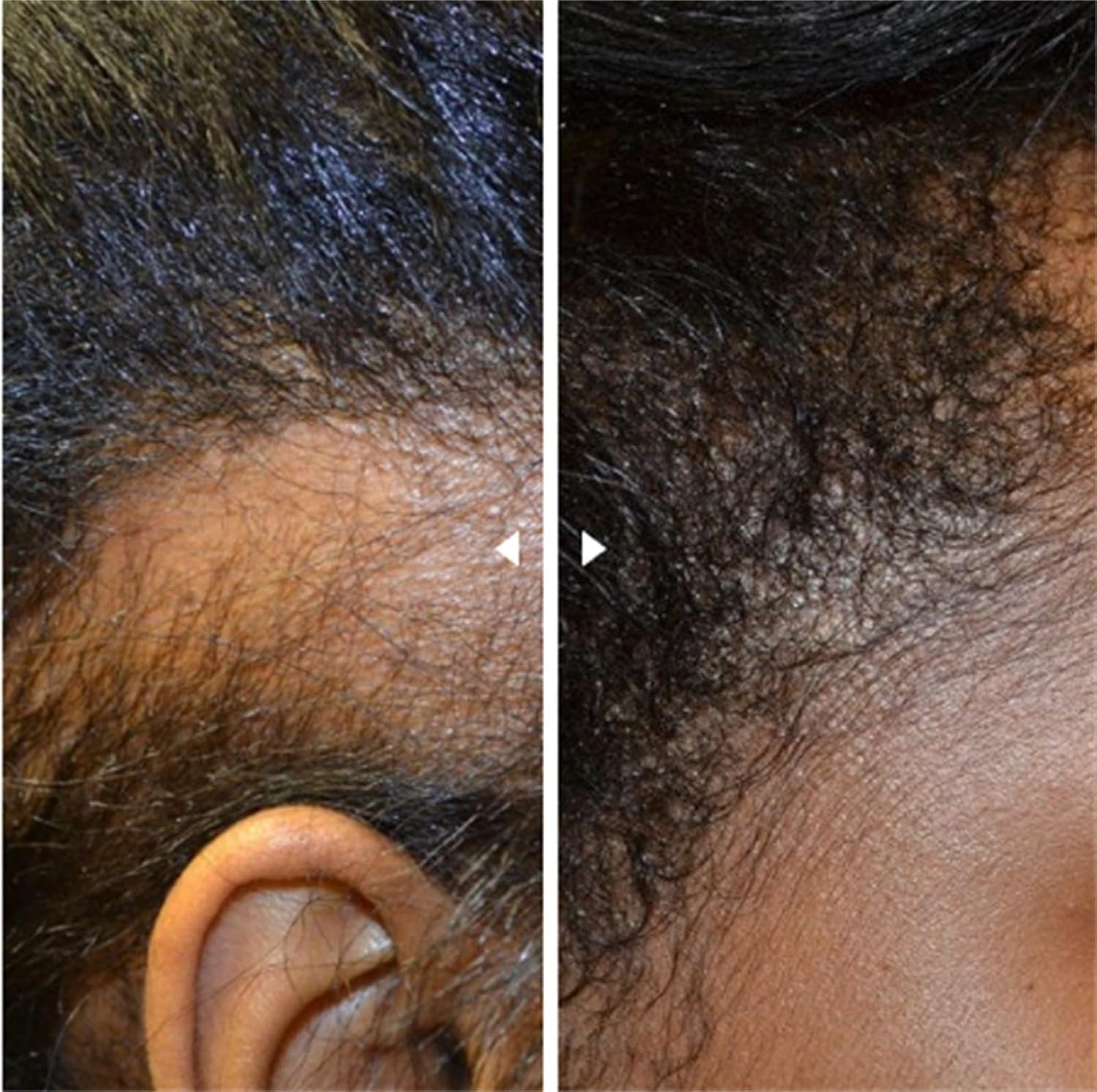 LYSYYAZ Deoxyribose Gel Hair Growth Serum, 60Ml, Unisex-Adults, Clear, Gel Form, for Hair Loss & Thinning, 1 Pcs image number 4