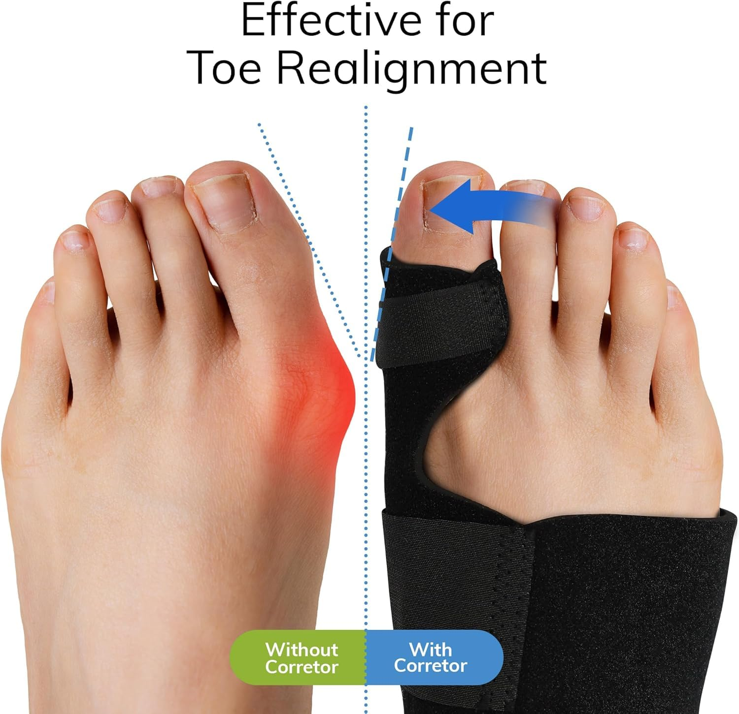 Bunion Corrector (2Pcs) Orthopedic Bunion Splint, Big Toe Separator Pain Relief, Non-Surgical Hallux Valgus Correction, Hammer Toe Straightener, Day Night Support image number 2