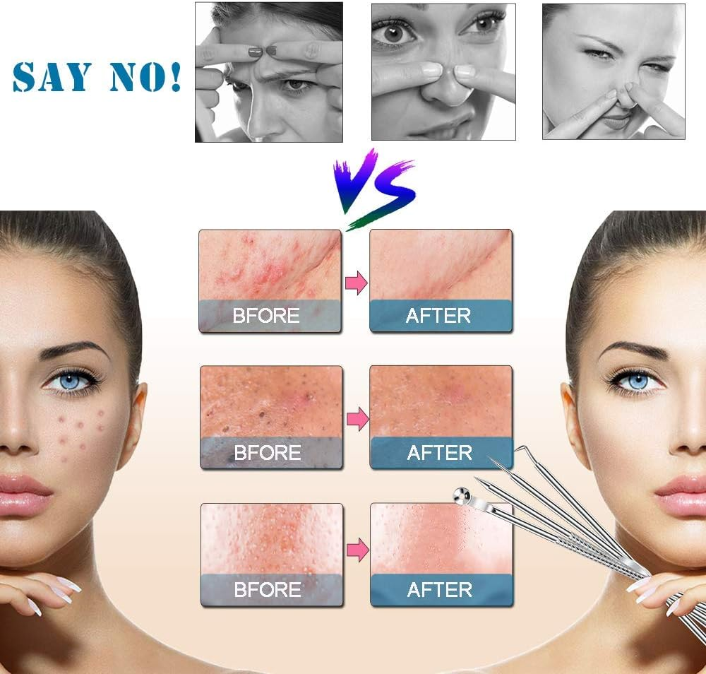 Blackhead Remover Kit, Extractor Removal Set Professional Stainless Steel Pimple Popper Tool Treatment for Whitehead Blemish Acne Comedone Pimple Popping (Silver) image number 5