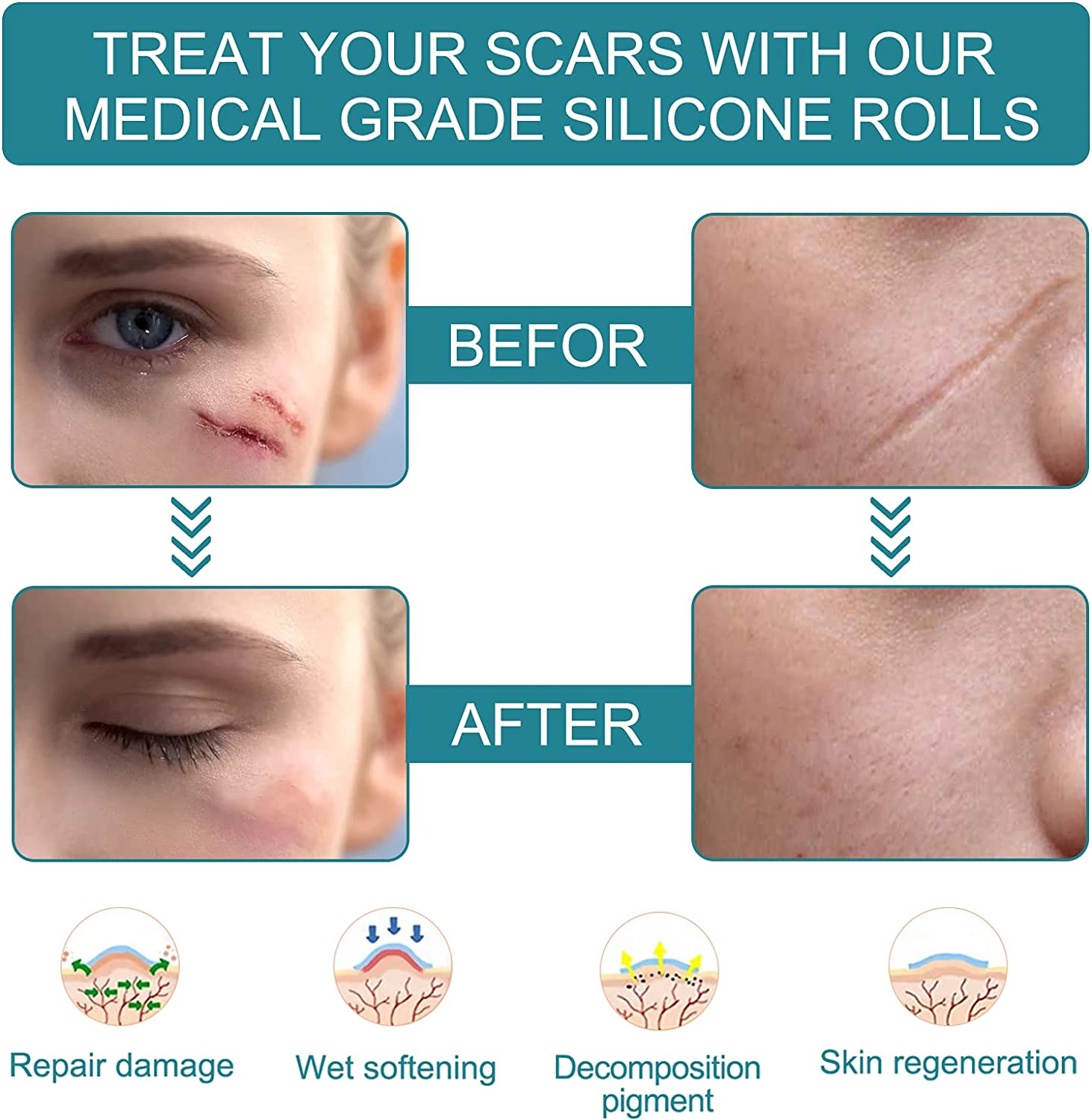 Silicone Scar Sheets, Professional Silicone Scar Sheets,Scar Silicone Tape Strips, Scar Removal Sheets for C-Section,Scar Removal Sheet Long Strips for Acne Burn, Keloid (1.6&rdquo; X 60&rdquo;) image number 2