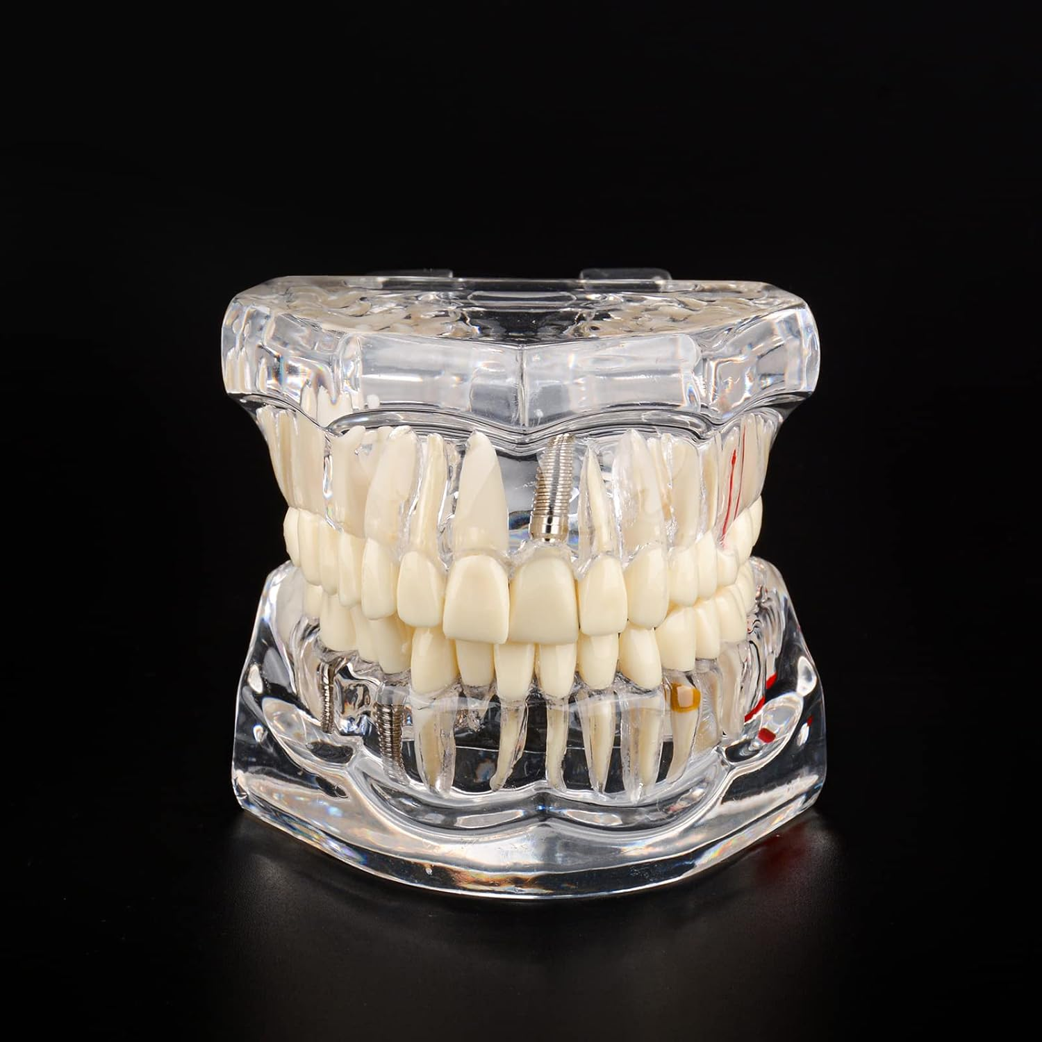 Ultrassist Transparent Disease Teeth Model image number 1
