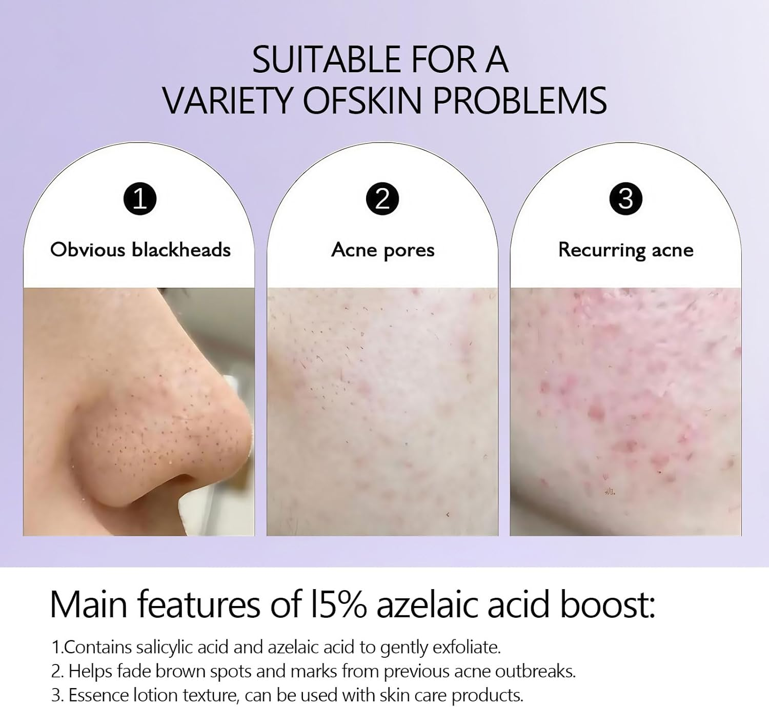 Ai-Uchoice Azelaic Acid 10% Cream for Face Body, 0.7 OZ Azelaic Acid Acne Cream Gel with Salicylic Acid for Skin Balancing Nourishing for Sensitive Skin Care & Daily Routines (Ai-Uchoice, 15% Azelaic Acid Cream) image number 1