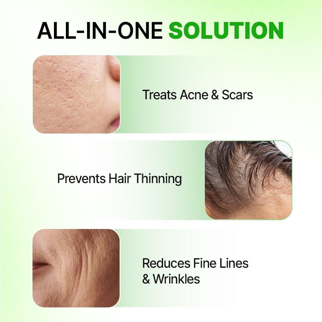 Sotrue Hair Growth Epifine Derma Roller 0.5 Mm with 540 Medical Grade Stainless Steel Needles, Activates Hair Follicles, Repairs Damaged Hair, for Face, Hair Fall & Hair Thickening, Reduces Acne Scars, Safe & Effective to Use image number 3