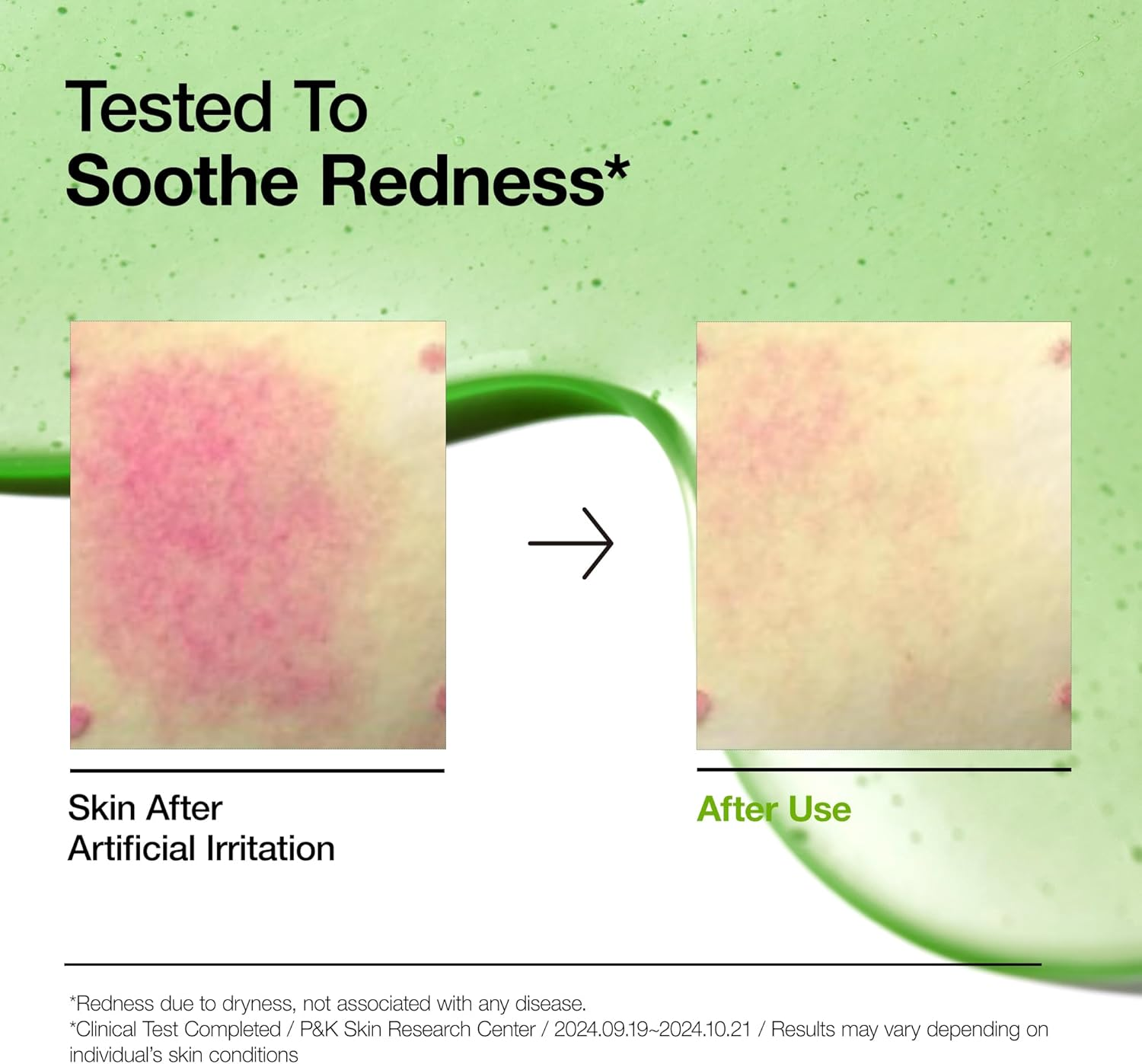 Anua Azelaic Acid 10 Hyaluron Redness Soothing Serum, Facial Serum for Blemish-Prone & Sensitive Skin, Lightweight & Hydrating Blemish Care, Hyaluronic Acid, Korean Skincare, 1.01 Fl Oz. image number 4