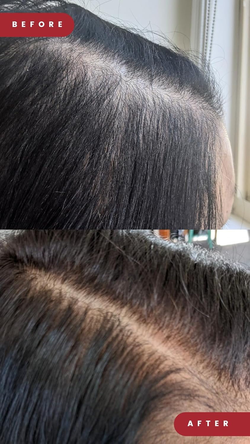 Grow Laser Cap 280 Medical Grade Laser Diodes for Hair Regrowth Men and Women, FDA Cleared, At-Home Hair Loss Regrowth Device, Low Level Laser Therapy (LLT) image number 4