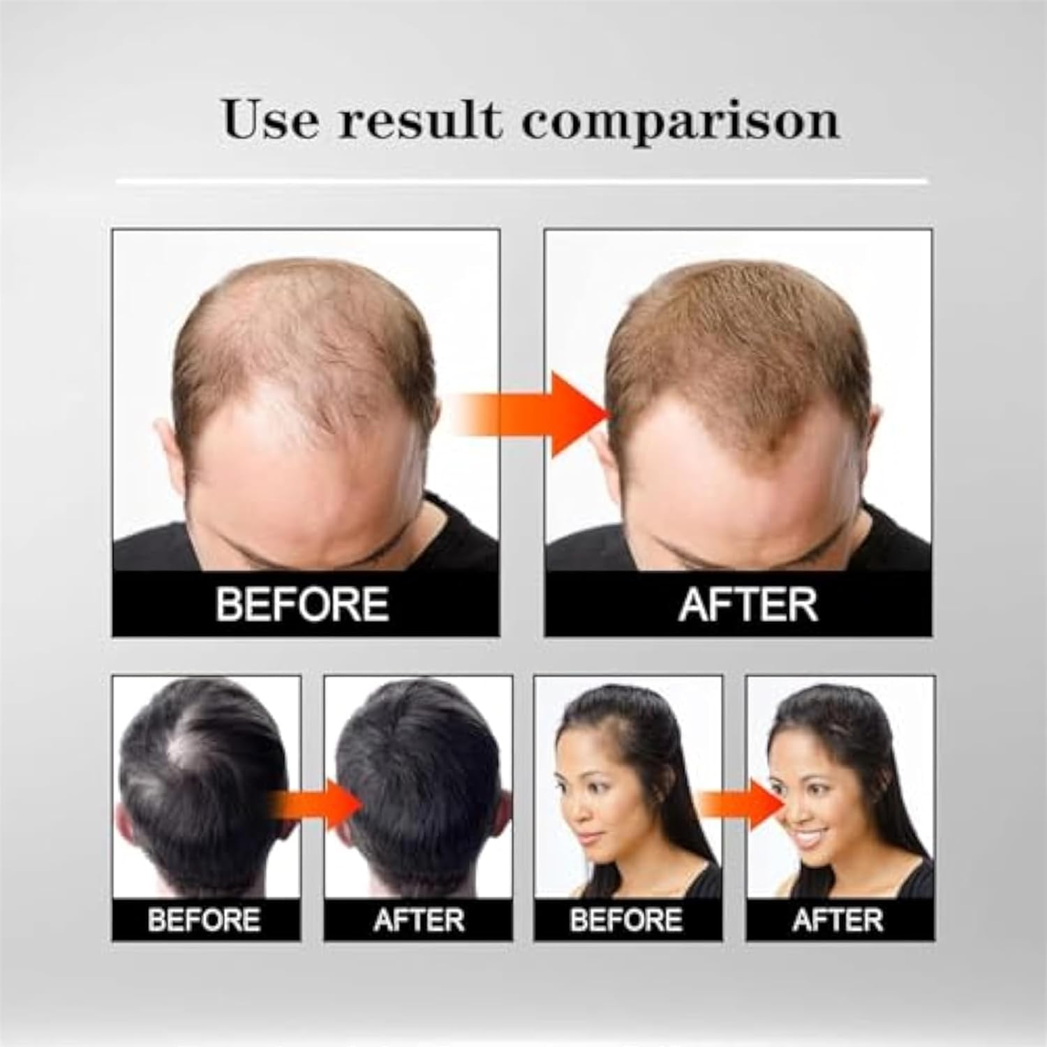 Alphainfuse Hair Regrowth System, Painless Microneedle Infusion Hairregrowth Solution, Scalp Nourishing Oil, Damage Repair, Loss Prevention, Enhances Thick Hair for Men Women (Typeb) image number 2