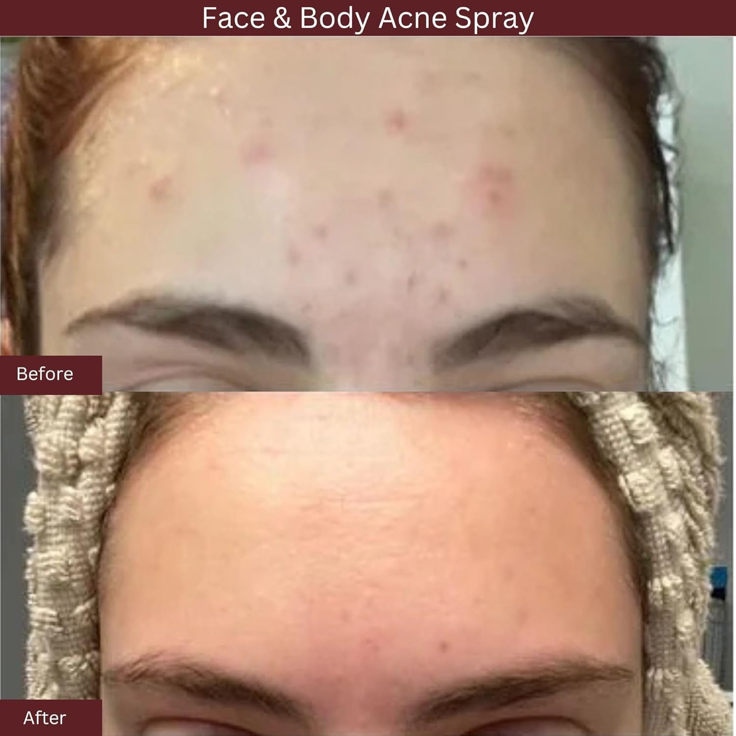 Blemish Treatment Mist by ITK for Unisex - 3.3 Oz Mist