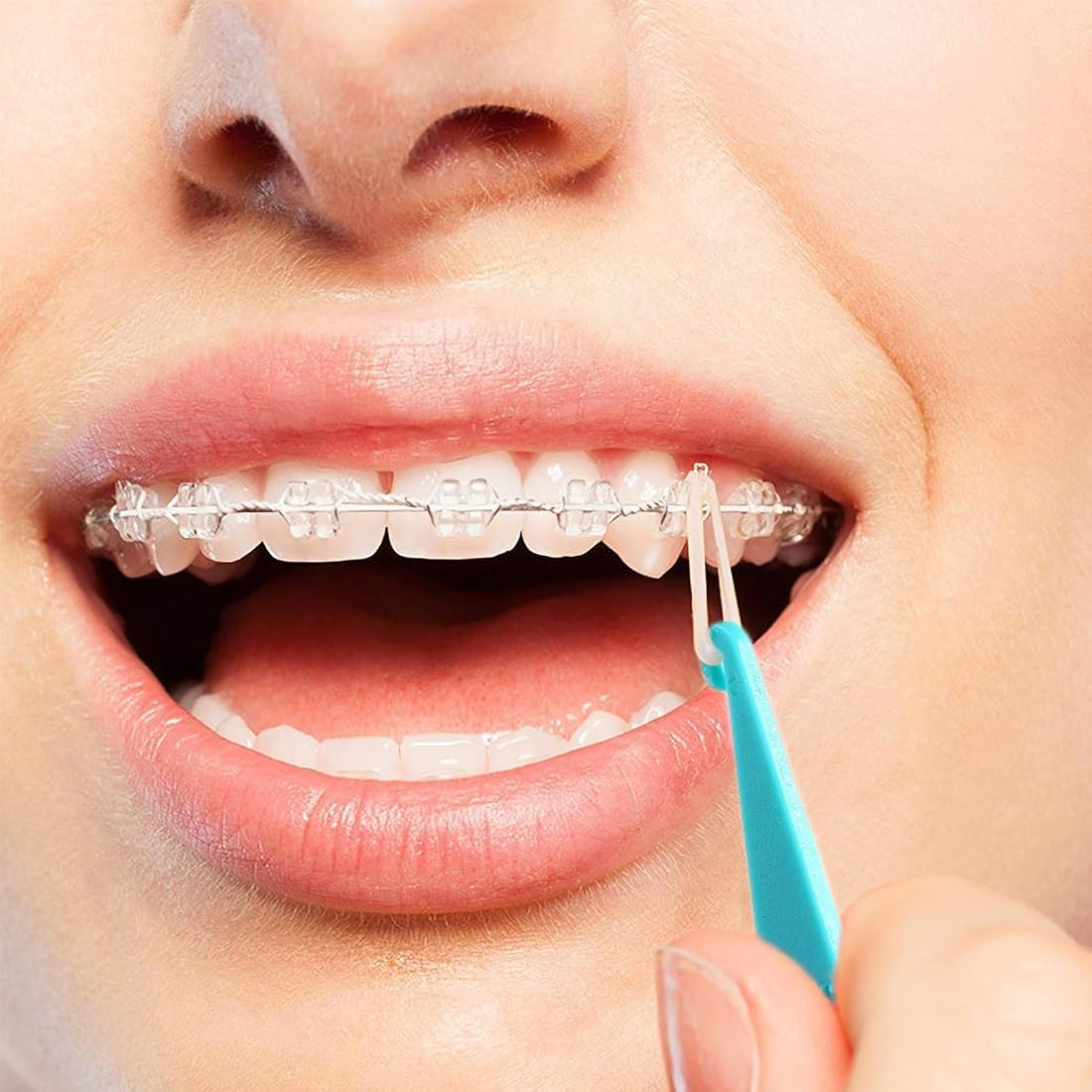 Pack of 10 Orthodontic Elastic Disposable Plastic Braces for Braces, Material Placement Removal Tools, Orthodontic Disposable Plastic Braces (Mixed Colour) image number 6