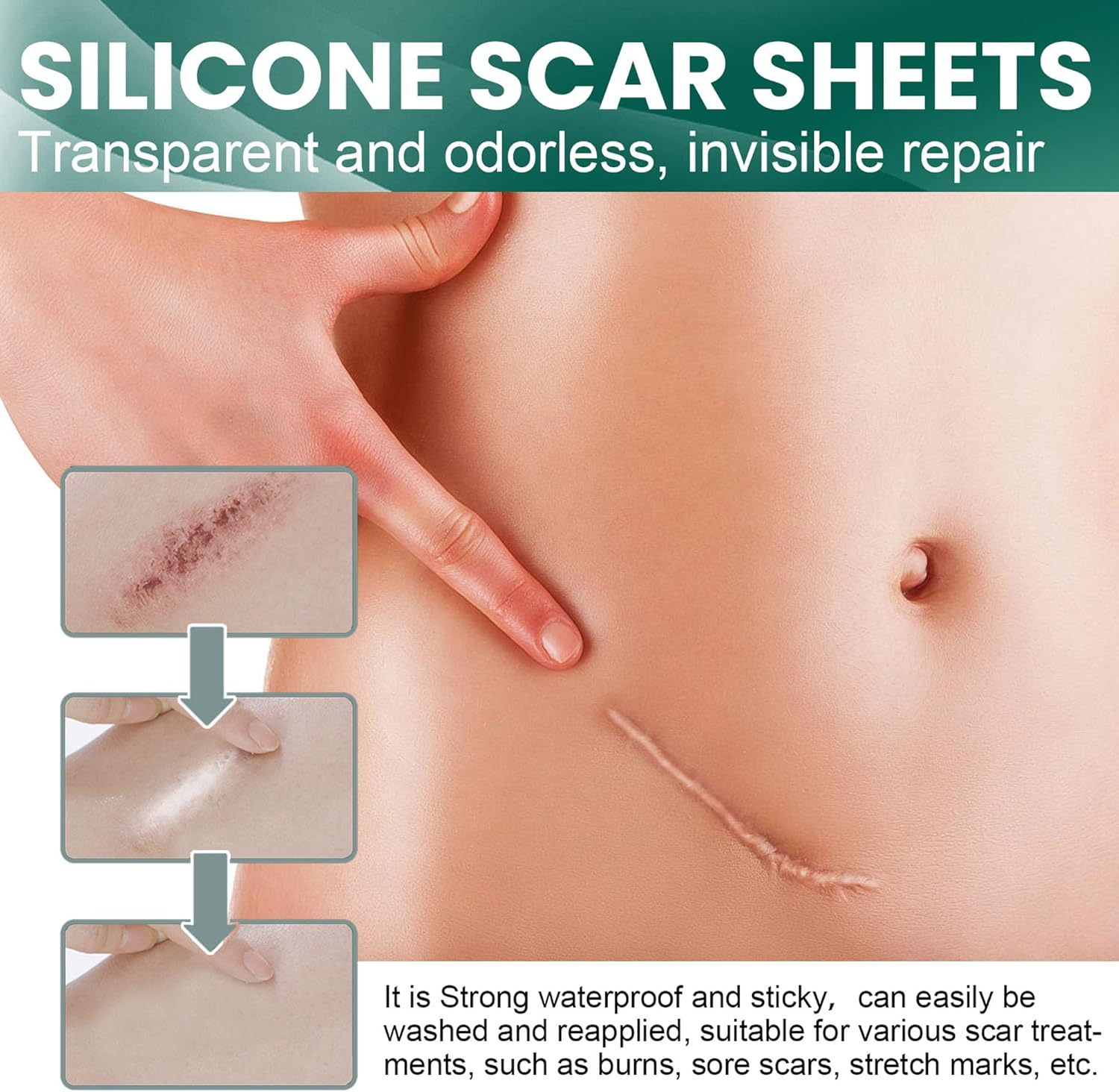 Silicone Scar Tape, Soft Silicone Scar Tape Painless Silicone Tape Roll for Surgical Keloid and Acne Scars (4 * 150Cm)