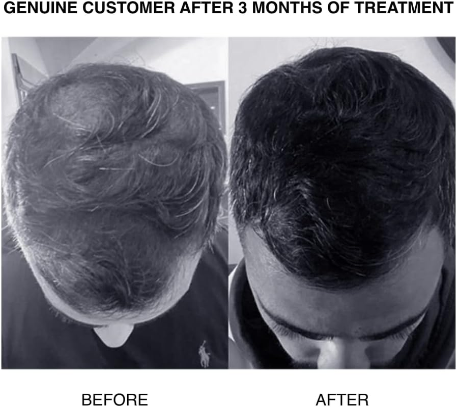 PATRICKS | CD plus Ultra Thickening Conditioner | DHT Blocker | Includes Zinc & Powerful Ingredients to Support Hair Growth & Care | for Moderate to Advanced Hair Loss | 200Ml image number 5