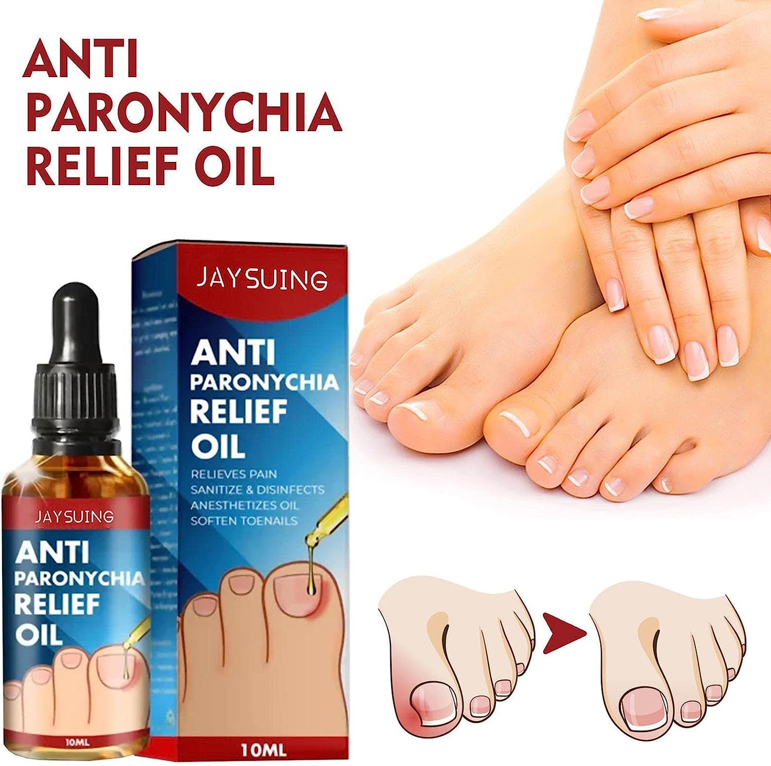 Anti Paronychia Relief Oil | Natural anti Paronychia Oil,Anti Paronychia Oil, Ingrown Toenail Removal, Paronychia Removal Oil for Damaged & Discoloration Nail