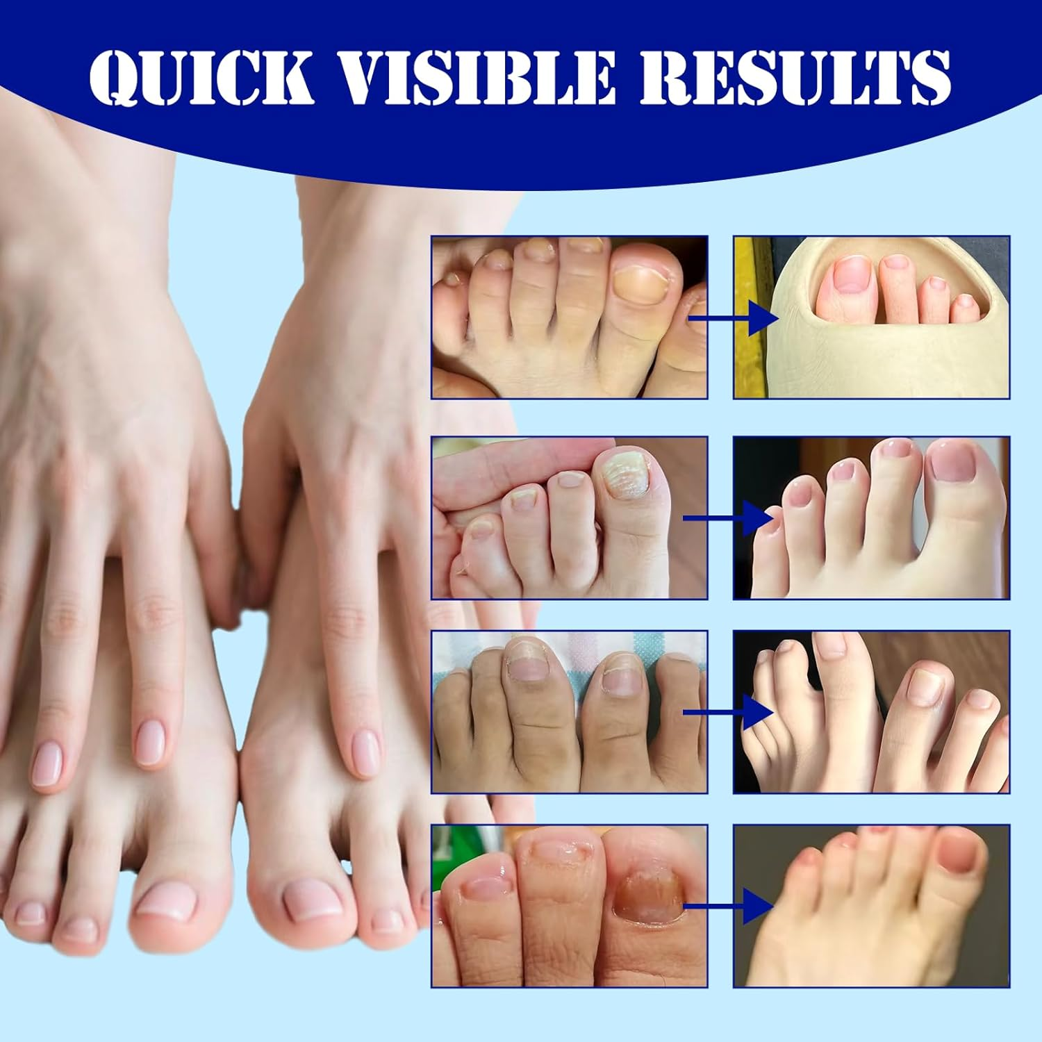 21PCS Fungal Nail Patches, Toenail Fungus Care, Nail Repair for Damaged Nails, Nighttime 8-Hour Nail Support for Damaged & Discoloured Toenails (A) image number 3