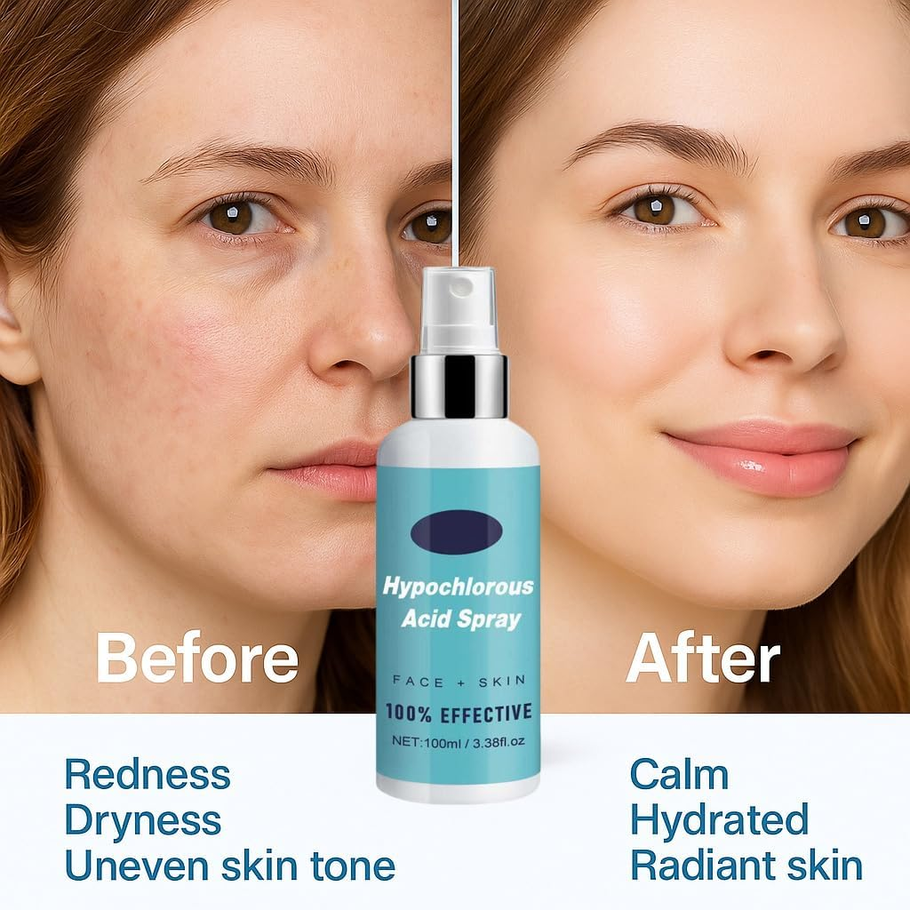 Hypochlorous Acid Skin Spray - 100Ml - for Acne Prone Skin, Dry Scalp, Face & Hand Cleanser, Eyelash Cleanser & Toner